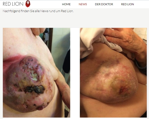 Datei:Red Lion Brustkrebs.jpg