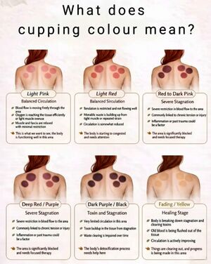 Schroepfen Cupping.jpg