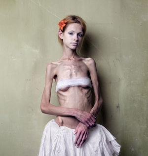 Anorexia2.jpg