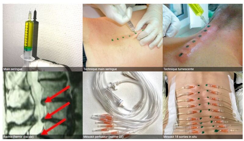 Datei:Perkutane Hydrotomie Bild2.jpg