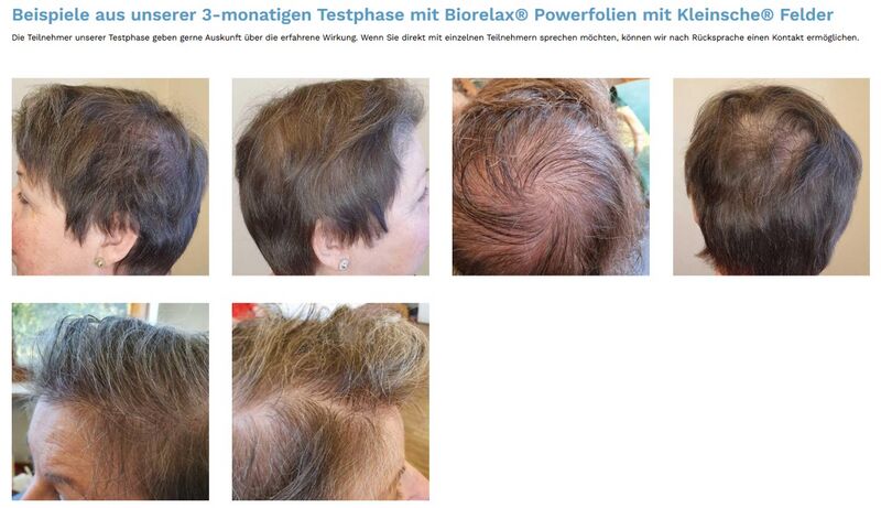 Datei:Kleinsche Felder Haarausfall.jpg