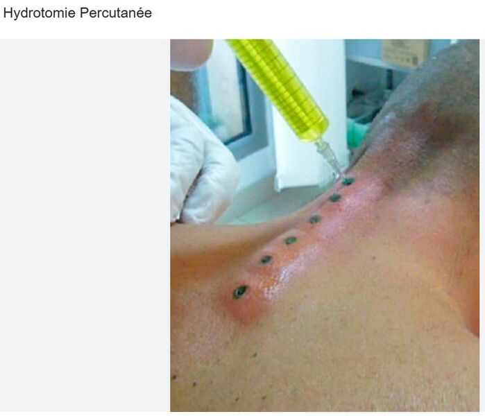 Datei:Perkutane Hydrotomie.jpg