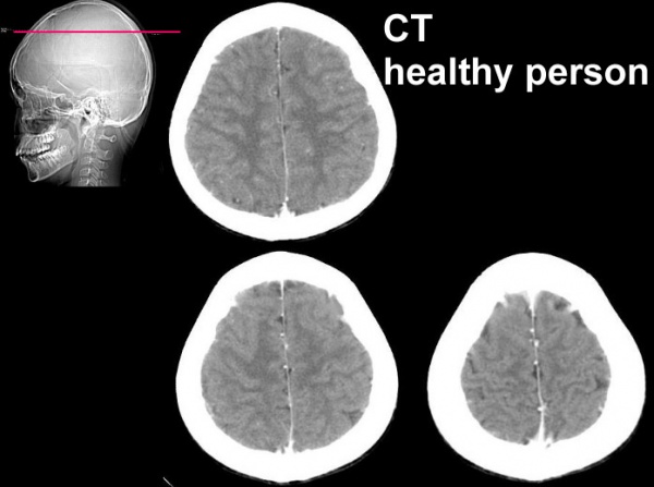 CT of a healthy subject
