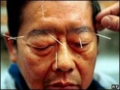 Acupuncture1.png